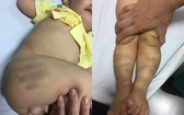 1歲多的男童遭虐待，送至醫院時遍體瘀傷。（圖源：互聯網）