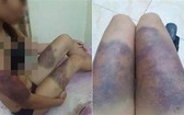 遭非法扣押毆打的孕婦阿Y遍體鱗傷。（圖源：Vietnamnet）
