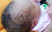 新生男嬰頭部縫了六針。（圖源：當事家庭提供）