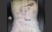 X光照片顯示，病童的大腸處呈現一片碎鏡的異物。（圖源：院方提供）