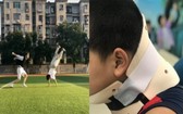 因模仿抖音(TikTok)視頻上的翻跟斗動作而扭傷了頸椎的10歲男童（右圖）。（圖源：田升）