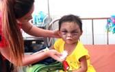 一名 4 歲的女童長期遭親母及繼父虐打，臉部遭重擊腫脹。
