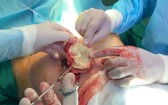 手術隊伍將患者在接受隆胸手術時被遺留的紗布取出體外。（圖源：C.T.V）