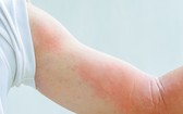 急性蕁麻疹的出現，是可能跟很多因素有關的。