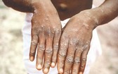 猴痘患者會長皮疹。