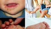 Ministry requests hospitals to monitor rise in hand-foot-mouth cases