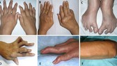 0,5% dân số Việt Nam mắc viêm khớp dạng thấp