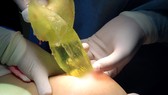Bác sĩ đang lấy túi ngực bị vỡ từ ngực bệnh nhân