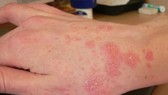 Ô nhiễm không khí, nguyên nhân chính gây ra các bệnh da liễu