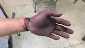 Vùng bàn tay và ngón tay của bệnh nhân tím, thiếu máu nuôi toàn bộ