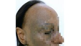 Bệnh nhân mắc bệnh lý về da và tóc hiếm gặp