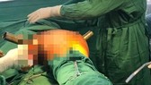 Cấp cứu thành công nam thanh niên bị ống sắt lan can cầu đâm xuyên vùng bẹn