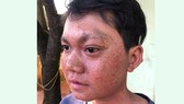 Từ bài viết “Xin cứu đôi mắt em”: Đưa em Liên đi phẫu thuật