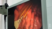 Ngủ quên, nuốt 3 cây tăm tre vào bụng