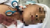 Cháu bé được chuyển tới bệnh viện cấp cứu trong tình trạng bị một chiếc kéo đâm sâu vào cổ gây thương tích nghiêm trọng