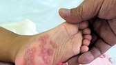 Sử dụng thuốc khác thay thế thuốc Phenobarbital điều trị bệnh tay chân miệng