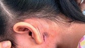 Lũ lụt kéo dài khiến bệnh Whitmore tăng đột biến