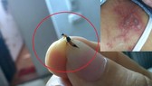 Kiến ba khoang (hình lớn) và một người bị viêm da dị ứng do độc chất từ kiến ba khoang (hình nhỏ)