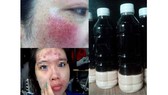 Một bệnh nhân bị sưng phù mặt vì sử dụng sản phẩm thuốc bắc tái tạo da không rõ nguồn gốc