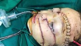 Khâu gần 300 mũi, cứu sống cháu bé bị cha chém nguy kịch