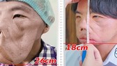 Gương mặt anh Mến sau 1 năm được bác sĩ Tú Dung điều trị thu gọn từ 26cm còn 18cm
