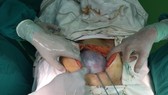Surgeons carry out the operation to remove the ovarian cyst (Photo: SGGP)