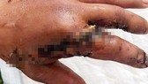 Surgeons reattach amputated forefinger, thumb