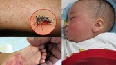 Dong Nai Province in shortage of HES200 against dengue fever shock