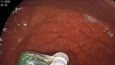 Viên sỏi thủy tinh trong thực quản bé trai 3 tuổi được các bác sĩ gắp kịp thời