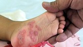 Bình Định: Bệnh tay chân miệng ở trẻ em tăng cao
