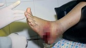 Phẫu thuật kịp thời chân bị nhiễm trùng nặng 