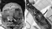 Bệnh nhân K. bị tổn thương nghiêm trọng vùng mặt và tay sau khi đốt pháo tự chế