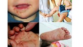 Gần 11.000 ca mắc tay chân miệng, Bộ Y tế khẩn cấp yêu cầu giảm tối đa số ca mắc và tử vong