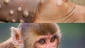 Đậu mùa khỉ lây từ người sang người qua quan hệ tình dục, lưu ý 3 thể bệnh