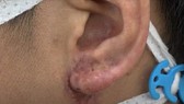 Tắc mạch, hoại tử do tiêm filler