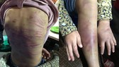 Hà Nội: Xử nghiêm vụ bé gái bị bạo hành, xâm hại tình dục
