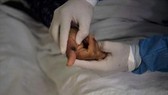 Indonesia xem xét điều trị miễn phí cho bệnh nhân mắc đậu mùa khỉ