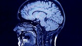 Nghiên cứu giúp hiểu rõ hơn về phát triển não bộ ở con người