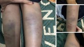 Đà Nẵng: Thực hư vụ học sinh bị đánh bầm tím