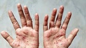 Health Ministry recommends measures to prevent monkeypox