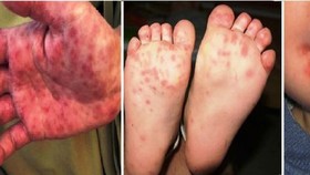 Ministry urges to prevent hand, foot and mouth disease