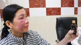 Bệnh nhân N.T.T.H bị viêm da tiếp xúc kích ứng do sử dụng mỹ phẩm trắng da cấp tốc mua trên mạng