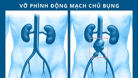 Cứu kịp thời cụ ông vỡ phình động mạch chậu chung