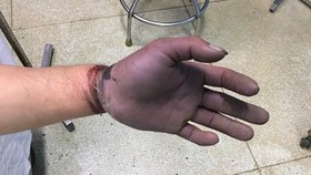 Vùng bàn tay và ngón tay của bệnh nhân tím, thiếu máu nuôi toàn bộ