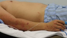 Một lần đi massage, thanh niên bị nhiễm não mô cầu