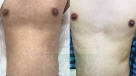 Phát hiện bệnh lý lây truyền qua đường tình dục hiếm gặp