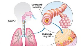 Bệnh phổi tắc nghẽn mãn tính - Sát thủ thầm lặng