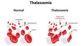 Nguy cơ mắc Thalassemia do thiếu máu, thừa sắt