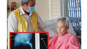 Thay khớp háng nhân tạo cho cụ bà 106 tuổi
