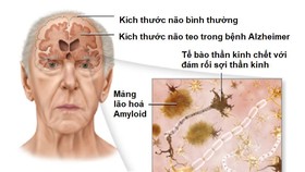 Cơ chế gây bệnh của bệnh Alzheimer và mức độ teo ở người bệnh Alzheimer